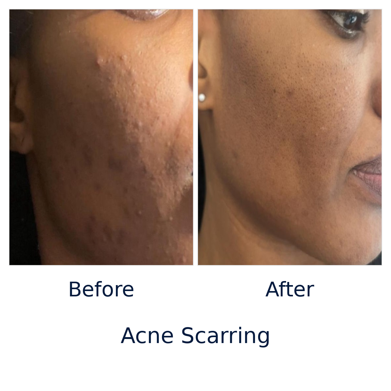 Acne_Scarring_Genuine_Before_After