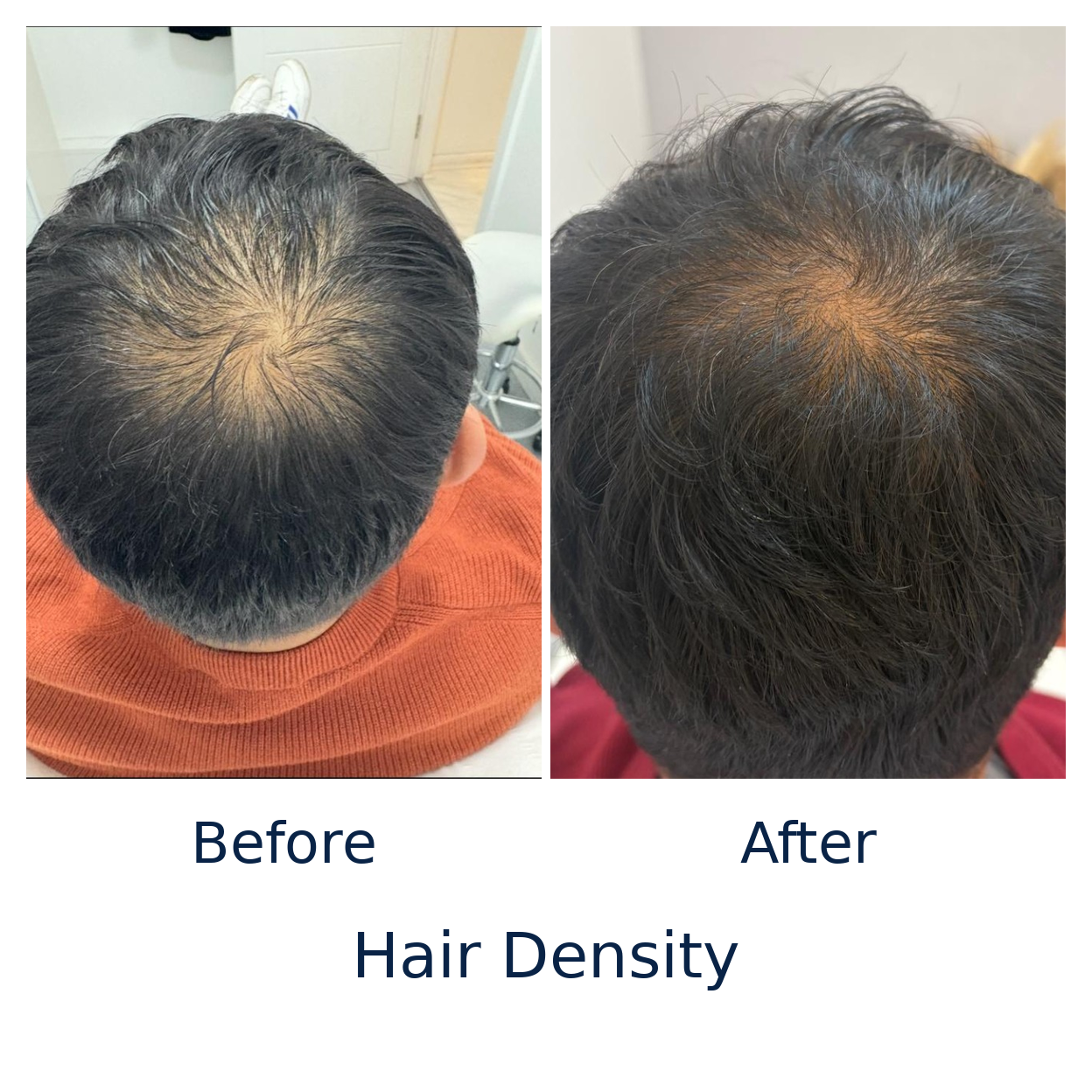 Hair_Density_Genuine_Before_After