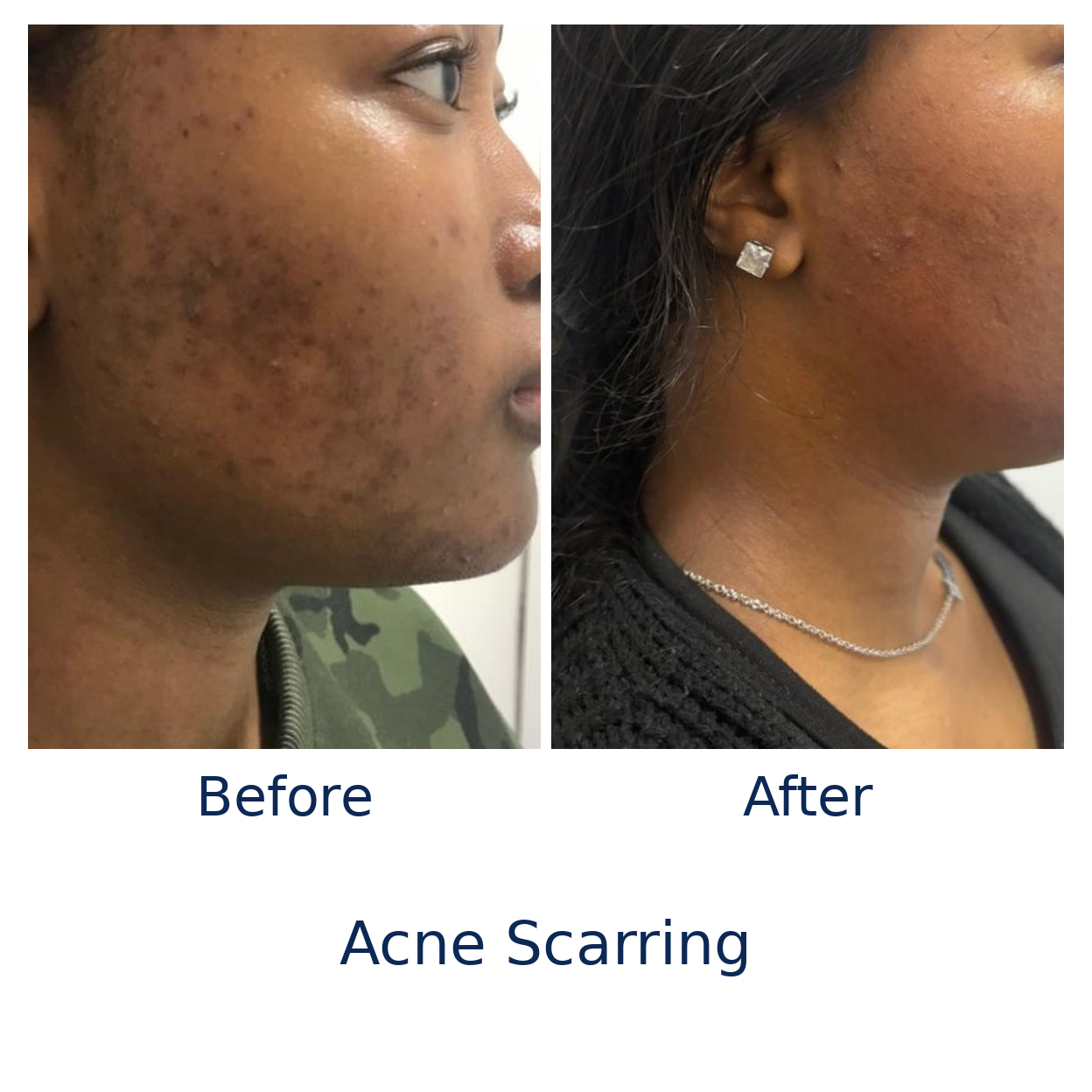 skin_clinic_acne_scarring_before_slightly_zoomed