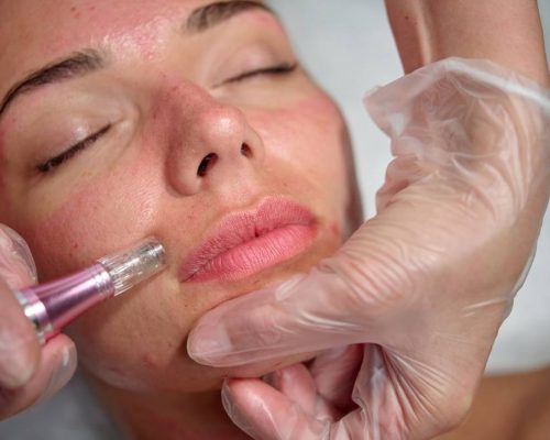 Microneedling 2 after